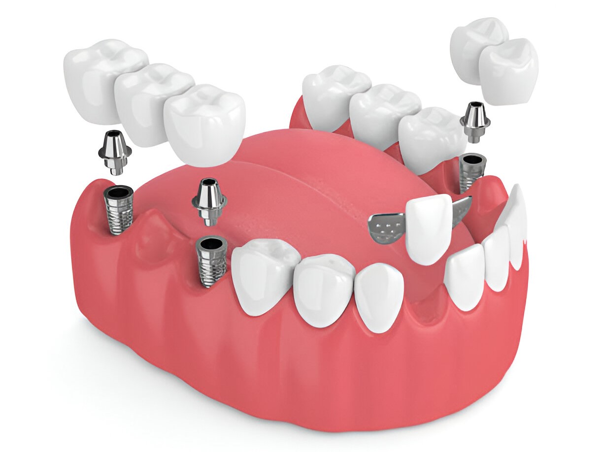 Best Dental Crowns And Dental Bridges in Bhayander